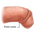 Freio curto 120x120 - FIMOSE Em Criança - 4 Passos GARANTIDOS Para Tratar Sem Cirurgia