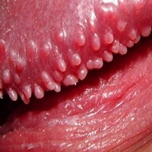 Glândulas De Tyson – Remova Em 7 Dias – Simples E Fácil