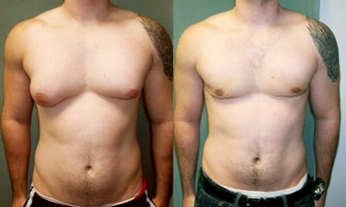 Antes e Depois Ginecomastia - Ginecomastia Tem Cura? O Que É, Valor Cirurgia E Recuperação