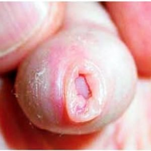 Fimose Causas – Saiba Tudo, O Que É, Tratamento e Dicas