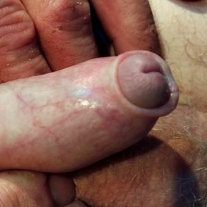 Como Tirar A Fimose Manualmente – Método 100% Caseiro Online