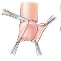 postectomia 120x120 - Cirurgia de fimose porque fazer! Saiba se você deve fazer.