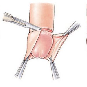 Cirurgia De Fimose – Saiba O Valor Da Cirurgia De Fimose
