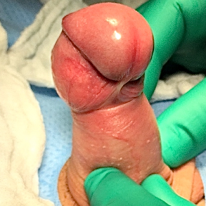 Cirurgia De Freio Curto Valor – Saiba Tudo Sobre A Cirurgia