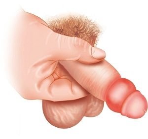 Parafimose – O Que é Principais Sintomas e Tratamento