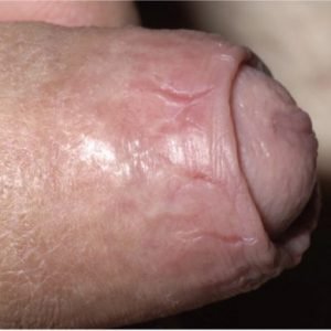 O Que a Fimose Pode Prejudicar? A Fimose Afeta a Vida Sexual?