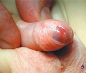 O Que é Fimose Explique! O Melhor Tratamentos P/ Fimose