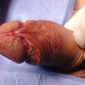 Como tirar o freio do pênis em casa, sem dor e sem cirurgia