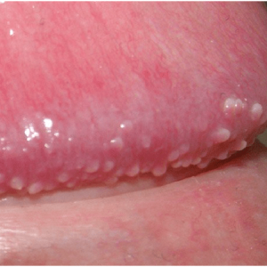 5 Ingredientes para remover as GLÂNDULAS DE TYSON em casa