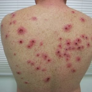 O que é Sifilis descubra – Será que a Sifilis pode danificar o coração?