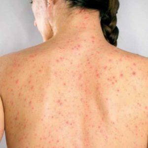 Sífilis Secundária Sintomas – Saiba tudo hoje