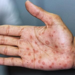 Sifilis Sintomas – Saiba quando procurar um médico