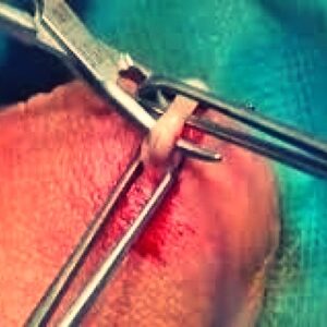 Possíveis Complicações da Cirurgia de Fimose