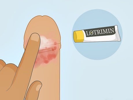 Mau cheiro e inflamação do prepúcio: dicas de higiene para evitar inflamações