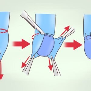 Tenho fimose: a cirurgia é realmente necessária?
