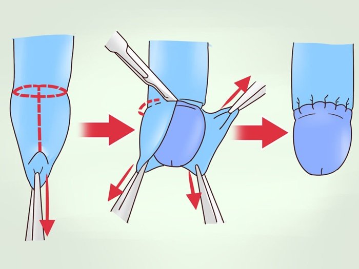 Tenho fimose: a cirurgia é realmente necessária?